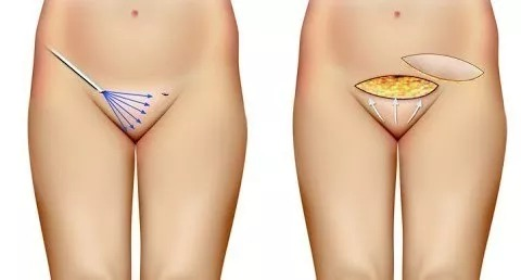 Mons Pubis Reduction & Lift Surgery by Chicago Plastic Surgeon 