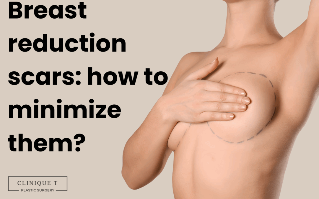 Breast reduction scars how to minimize them?